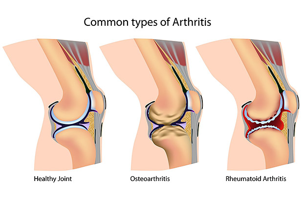 Nutrition and Arthritis